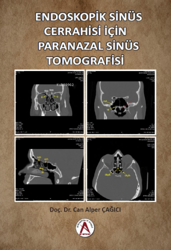 Endoskopik Sinüs Cerrahisi İçin Paranazal Sinüs Tomografisi | Nazan Öz