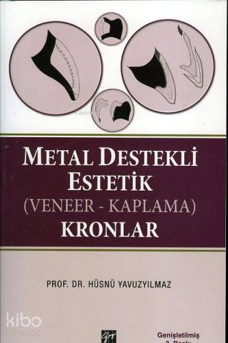 Metal Destekli Estetik (Veneer - Kaplama) Kronlar | Hüsnü Yavuzyılmaz 