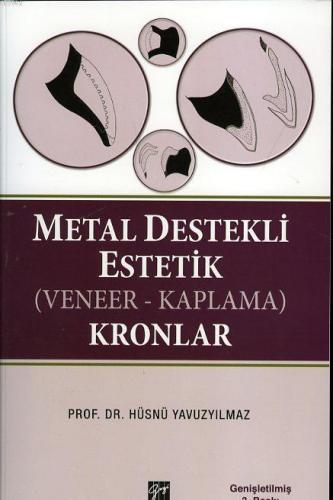 Metal Destekli Estetik (Veneer - Kaplama) Kronlar | Hüsnü Yavuzyılmaz 