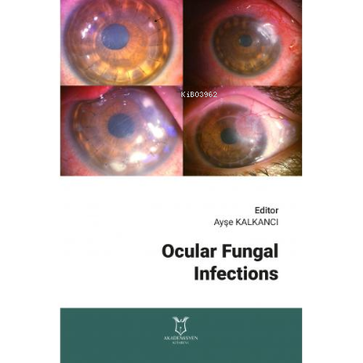 Ocular Fungal Infections | Ayşe Kalkancı | Akademisyen Kitabevi