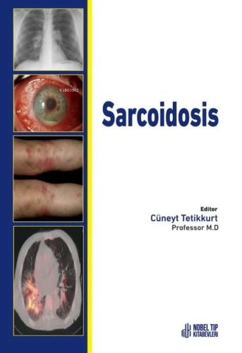 Sarcoidosis | Cüneyt Tetikkurt | Nobel Tıp Kitabevi