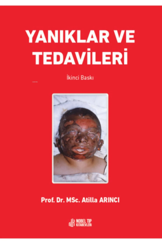 Yanıklar Ve Tedavileri | Atilla Arıncı | Nobel Tıp Kitabevi